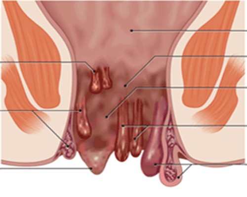 Piles Doctor in Chennai