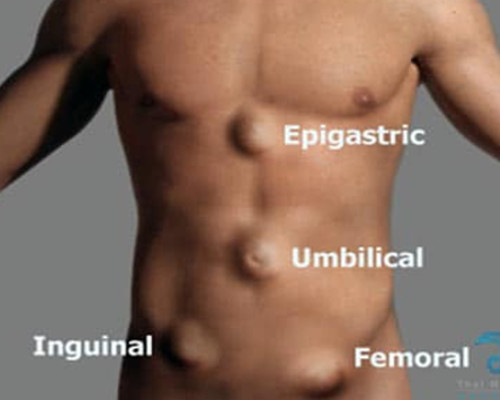 Hernia Hospital in Chennai